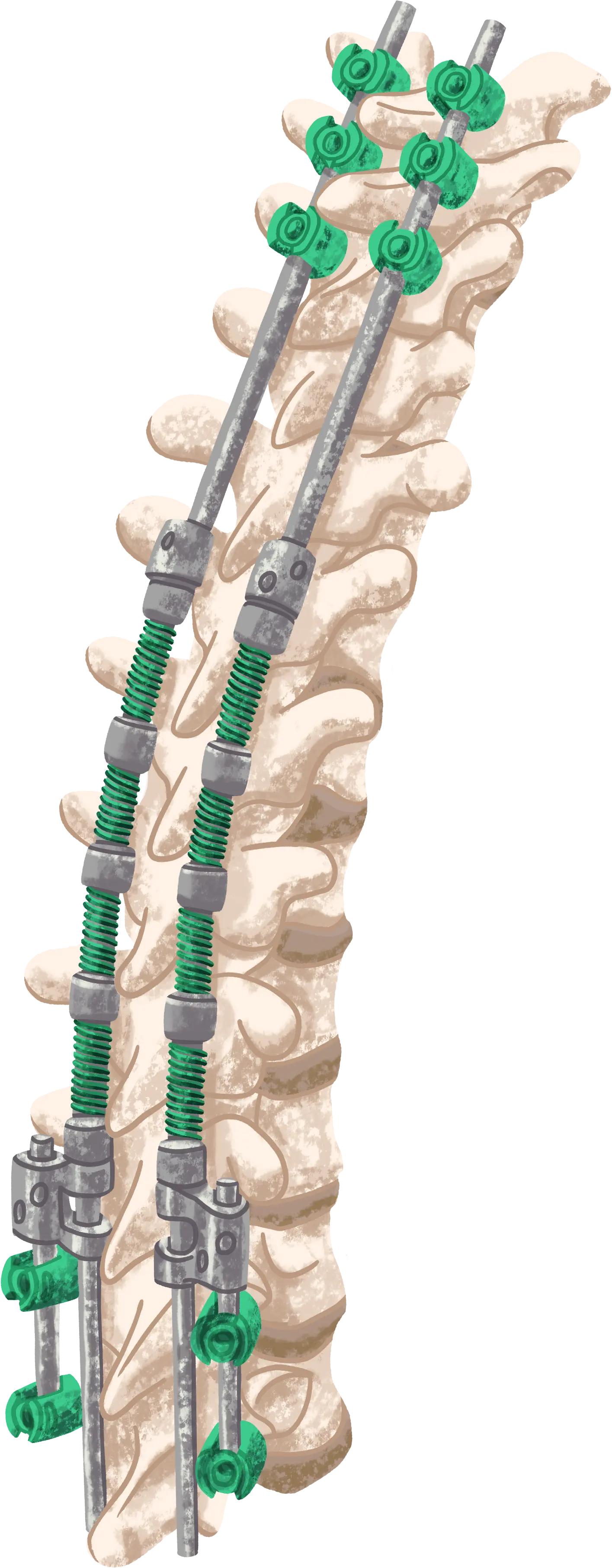 The Spring Distraction System implanted along a child&rsquo;s spine