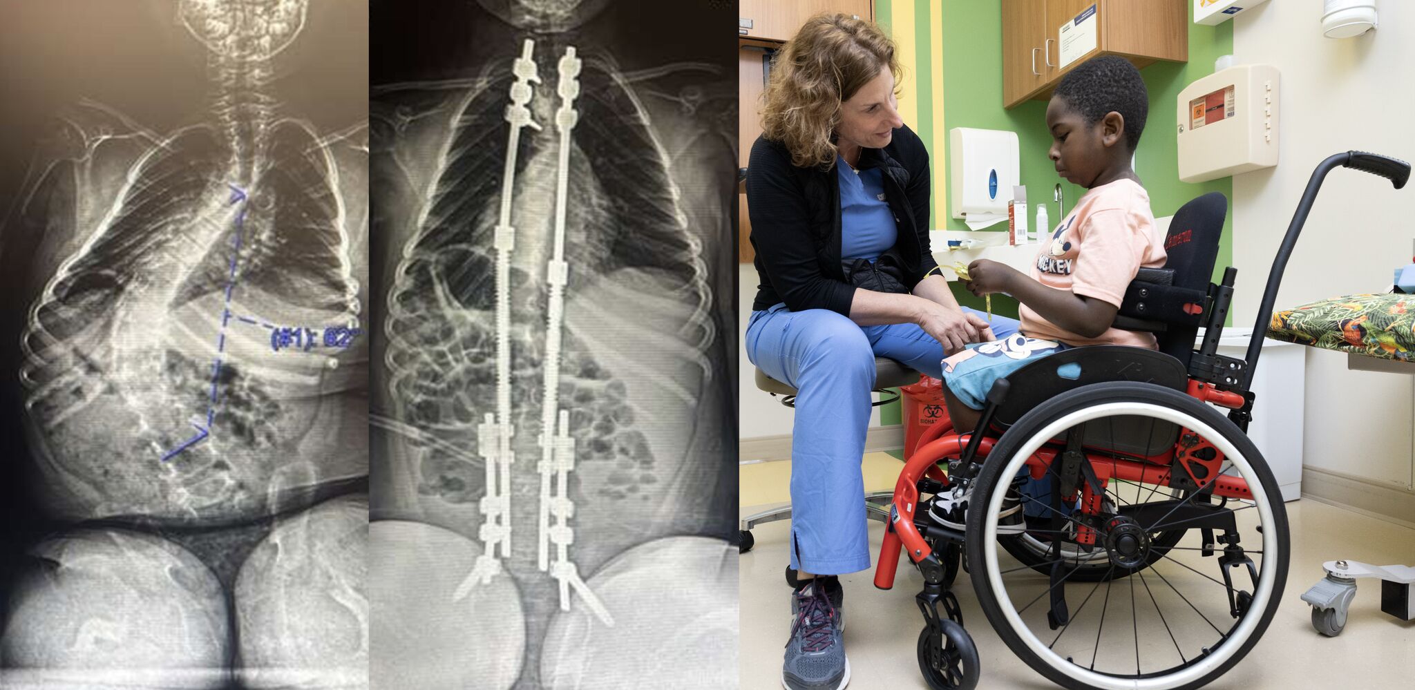 Pre- and post-operative X-rays of the patient&rsquo;s spine, the second showing the implanted rods, beside a clinician sitting with the young patient at Scottish Rite for Children